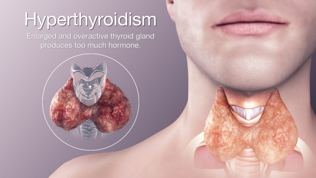 hyperthyroidism