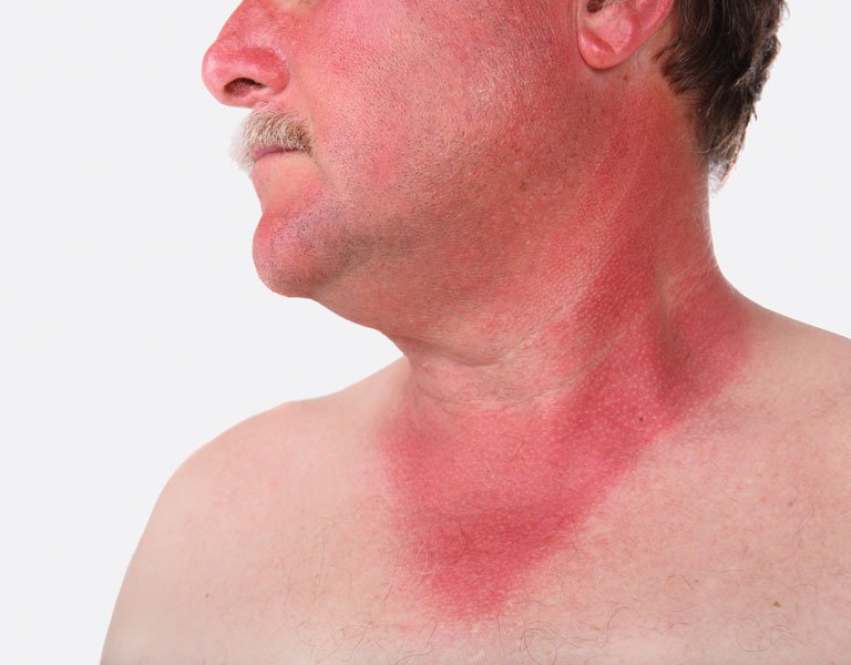 sunburn