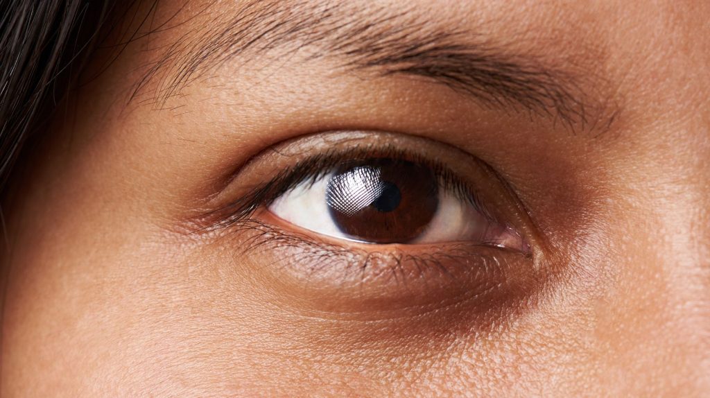 Dark circles