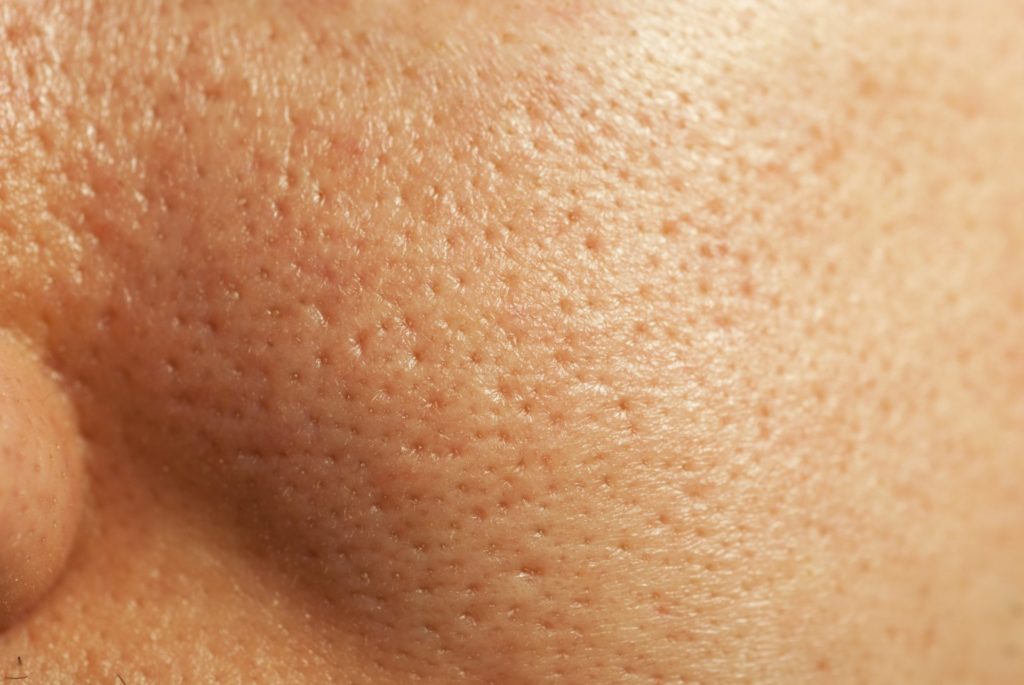 Open pores