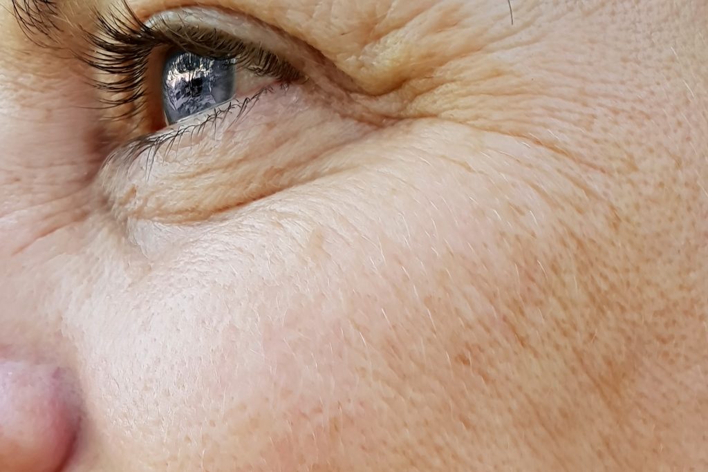 wrinkles