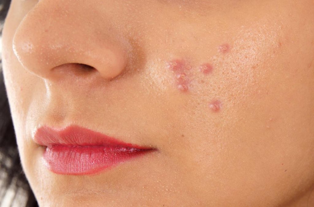 acne shows only on face