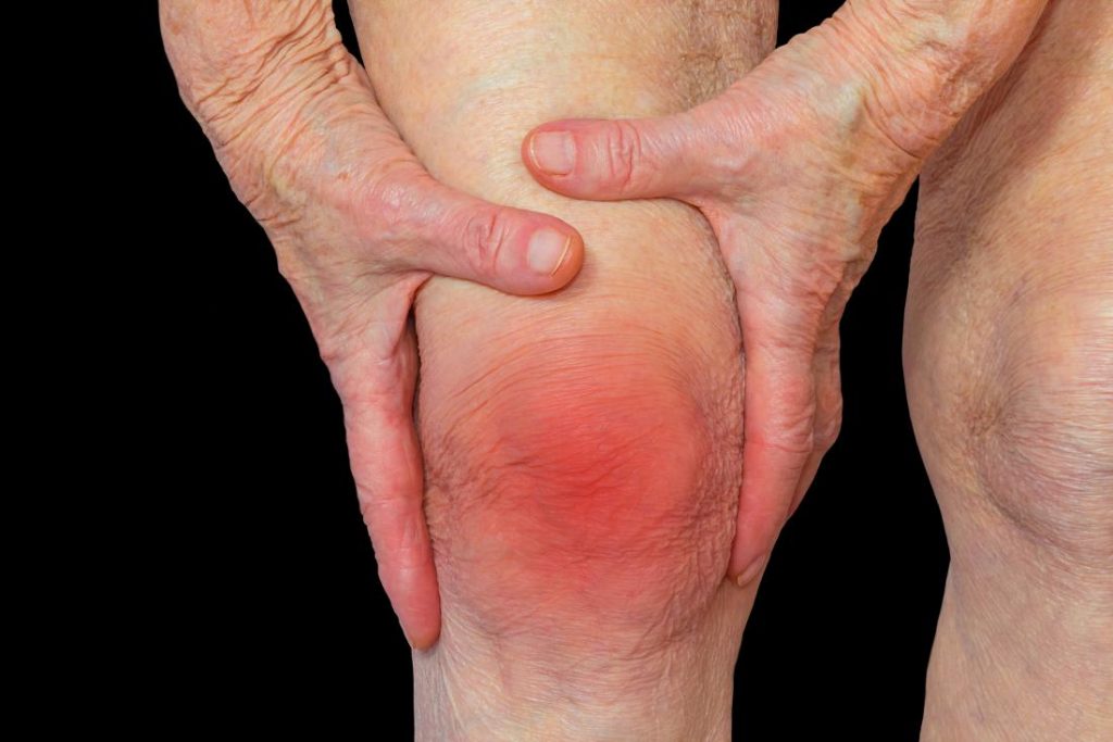 arthritis