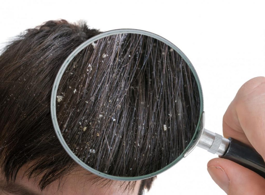 Are you suffering from stubborn dandruff?