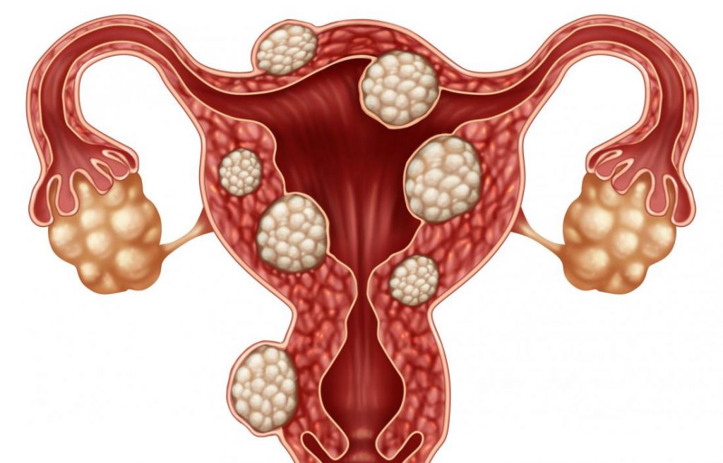 Fibroids