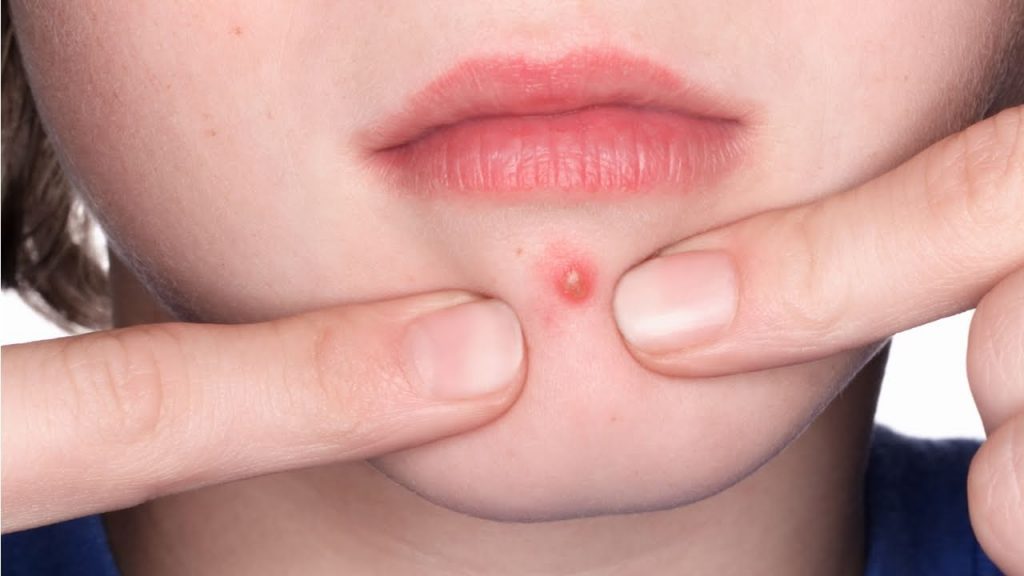 popping pimples
